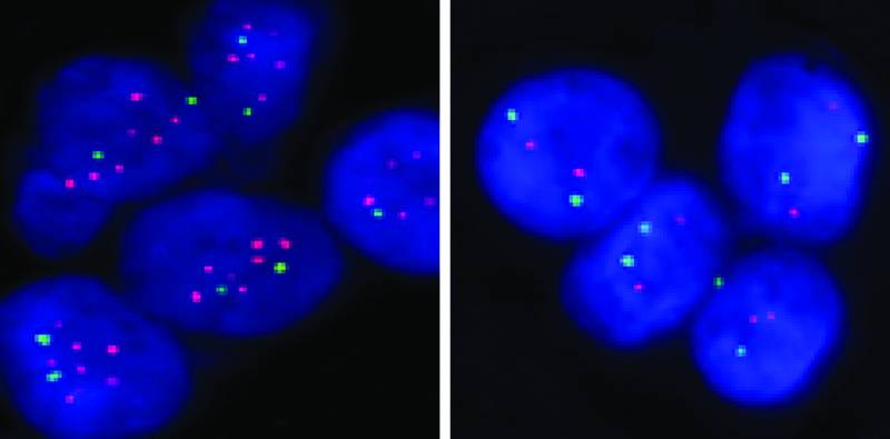 Identificado el gen responsable de las metástasis de cáncer de mama a huesos
