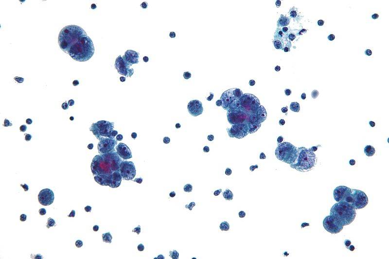 El análisis genómico del cáncer de ovario arroja nuevas pistas