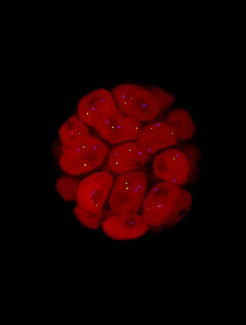 Identifican una alteración genética que aumenta el riesgo de síndrome de Cowden