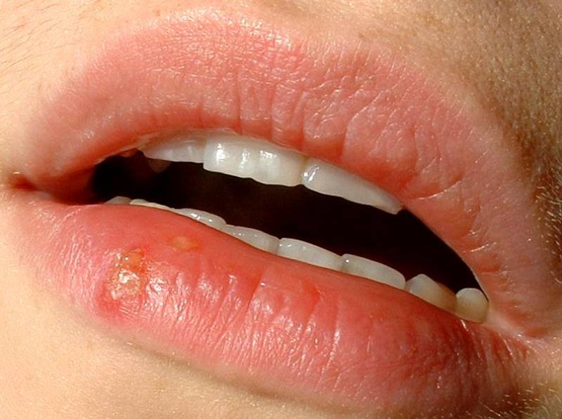 La inmunoterapia viral para el cáncer de piel muestra beneficios para el paciente 