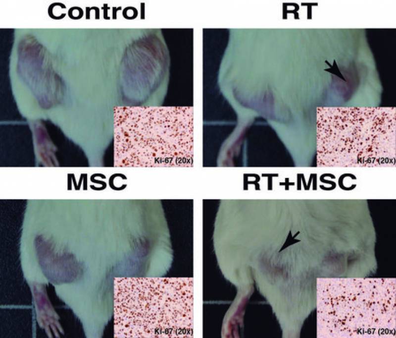 Un tratamiento más efectivo contra el cáncer combina radioterapia y células madre