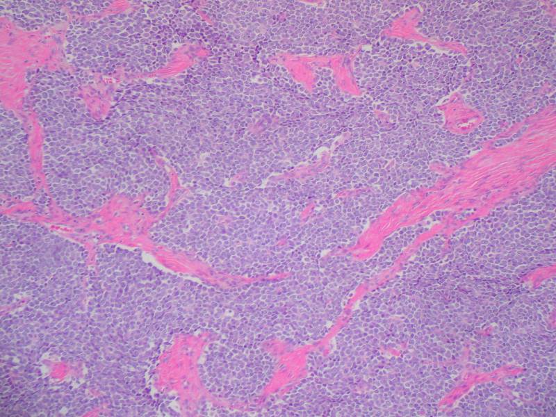 Una proteína de la membrana celular provoca metástasis en un grave cáncer infantil