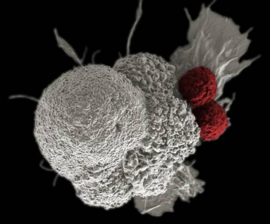Micrografía electrónica de un cáncer oral, donde las células tumorales (en blanco) son atacadas por las células T del sistema inmunitario (en rojo). La medicina personalizada busca vacunas consistentes en nanopartículas con carga del tumor del paciente que activen las defensas contra el cáncer. Imagen: NIH