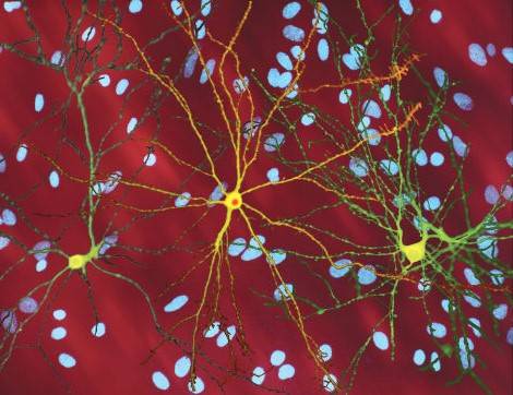 La huntingtina es la proteína que causa la enfermedad de Huntington. En la imagen, la neurona pintada de amarillo contiene una acumulación anormal de huntingtina, en naranja. / Wikipedia