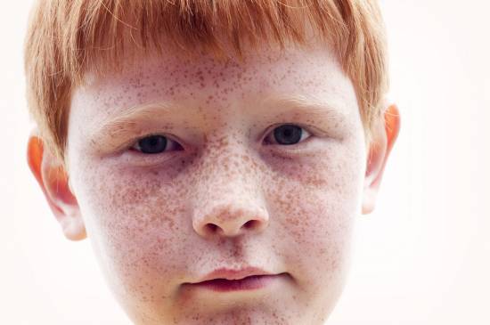 La fascinación provocada por el pelo rojizo y las pecas no siempre es positiva. Muchos niños pelirrojos sufren acoso debido a su color de pelo o de piel. Imagen: Vegar Norman