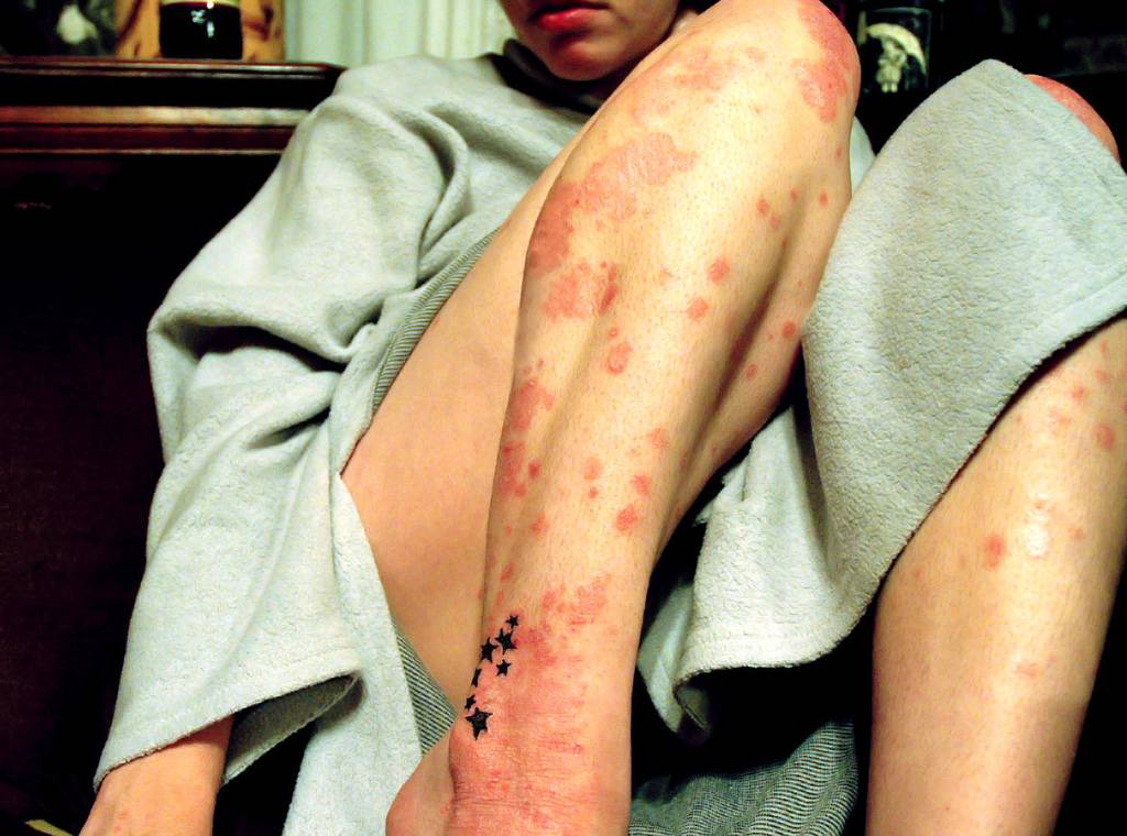 Descubren nuevas variantes genéticas asociadas a la psoriasis