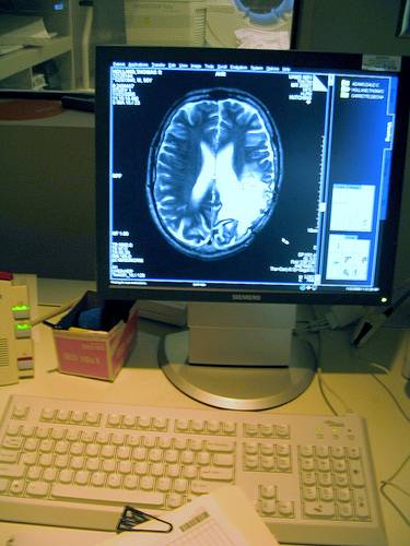 Los biomarcadores pueden predecir la respuesta a la terapia de un tumor cerebral