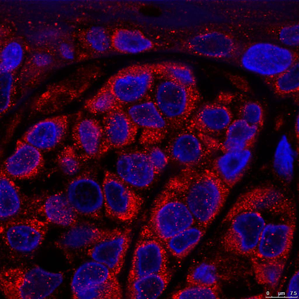 Descubren más de 40 genes que determinan la agresividad del melanoma