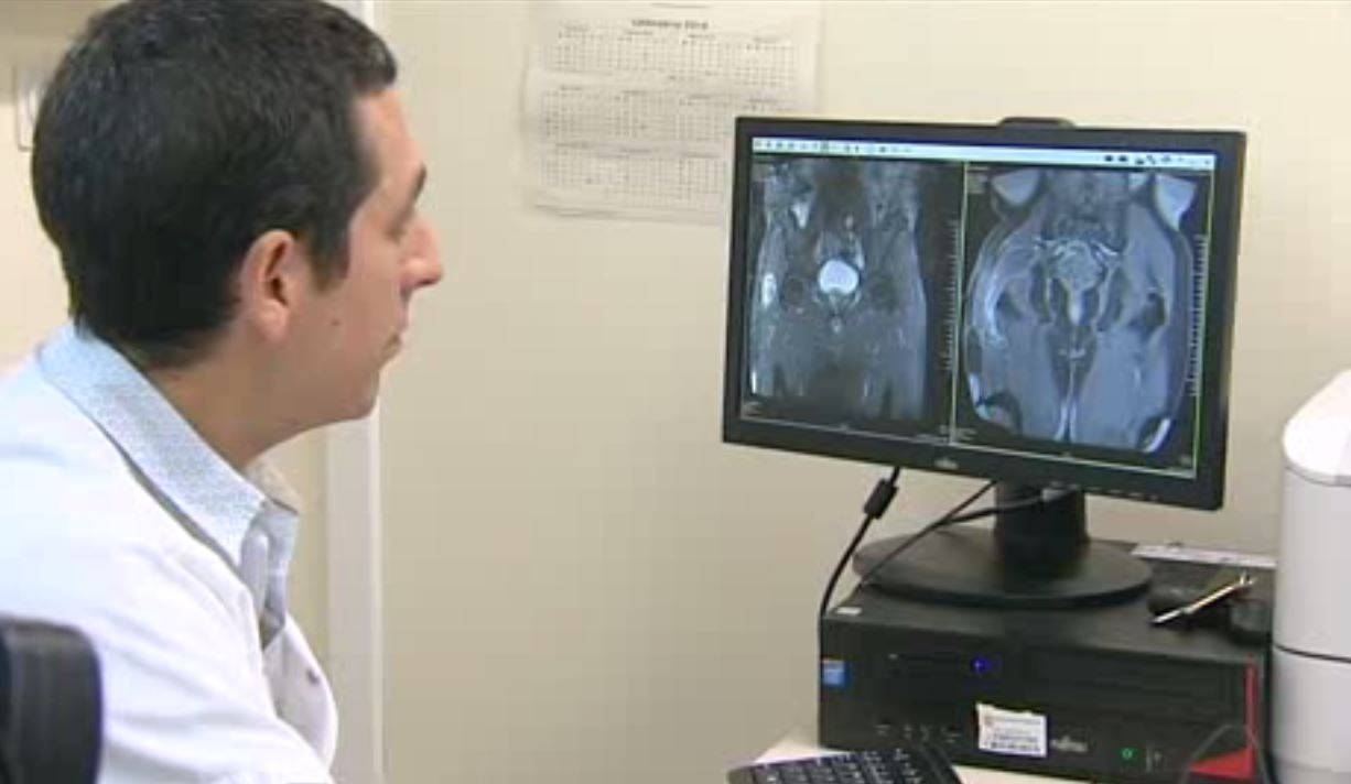 Médicos españoles reemplazan un músculo canceroso del glúteo por uno de la espalda