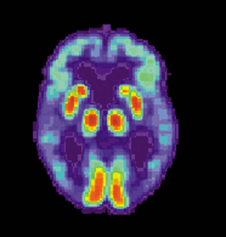 Atribuyen una 'posible' capacidad infecciosa a la enfermedad de Alzheimer