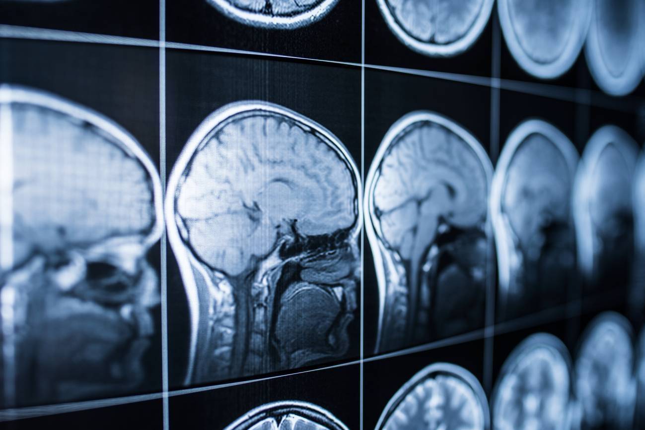 ictus, lenguaje, cerebro