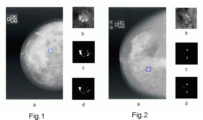 Las nuevas tecnologías aplicadas en la detección precoz del cáncer de mama
