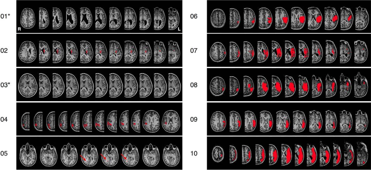 Los niños recuperan la funcionalidad cerebral del área afectada tras un ictus