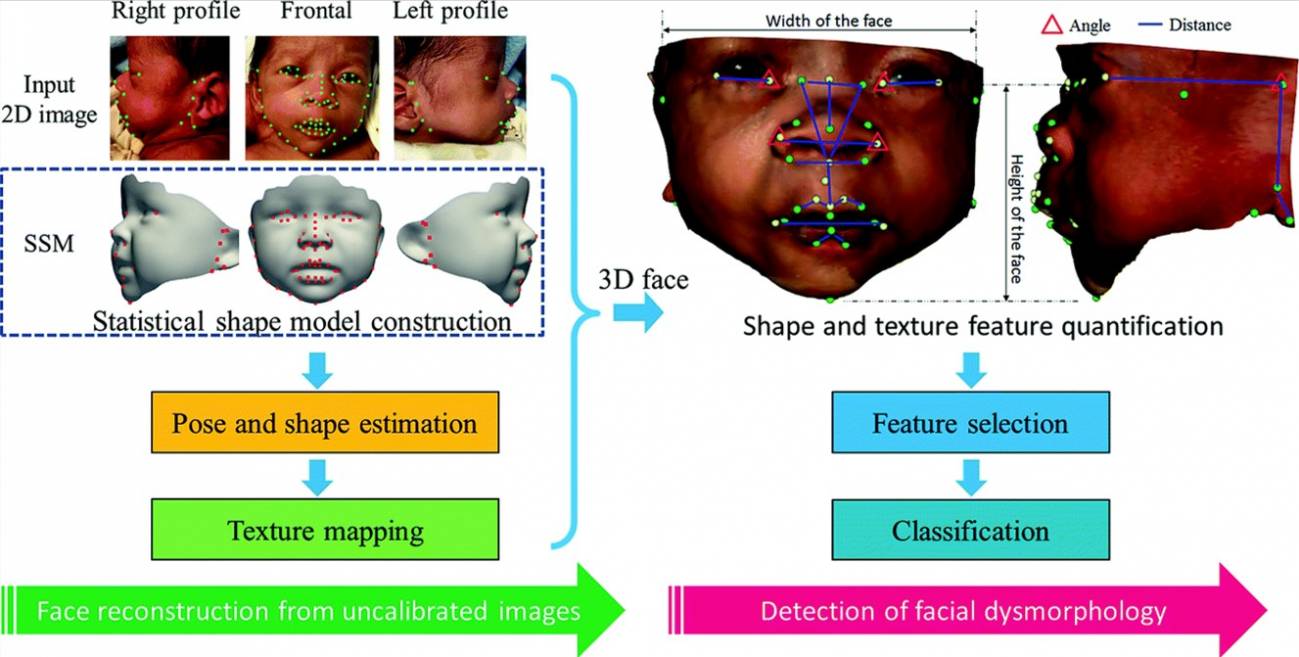 Un método de análisis facial detecta síndromes genéticos con alta precisión