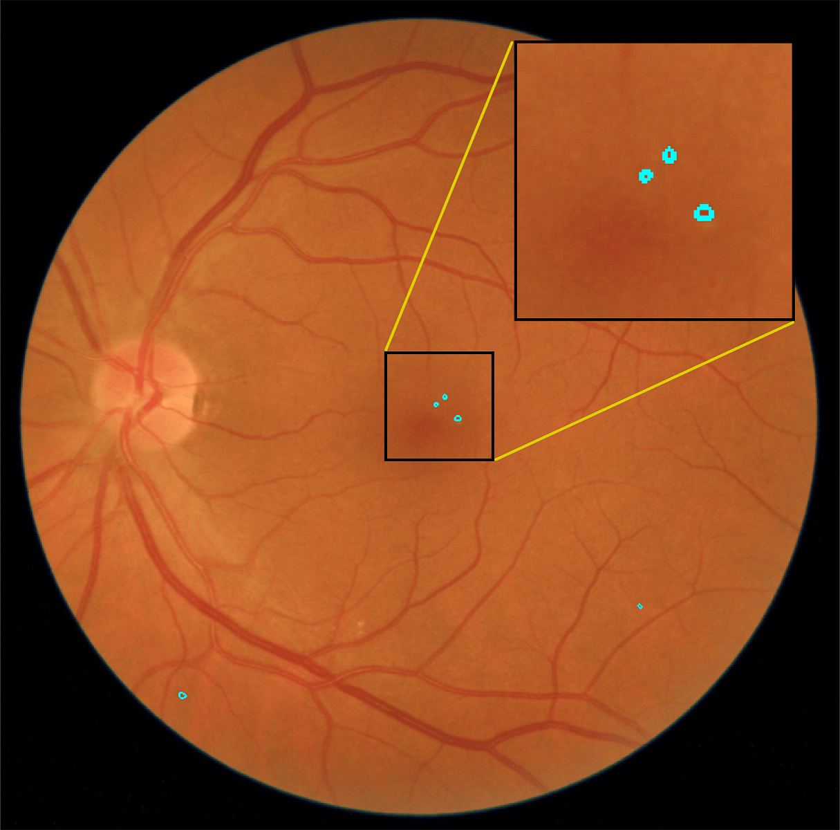Un sistema automático para detectar lesiones rojas en la retina