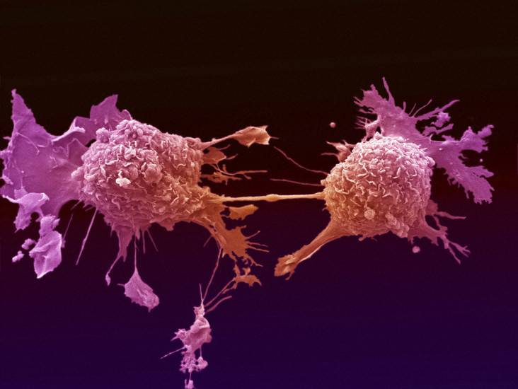 Célula tumoral de pulmón. / Wellcome Images