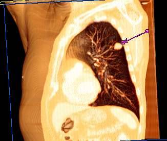 Descrifran 26 genes que promueven el cáncer pulmonar