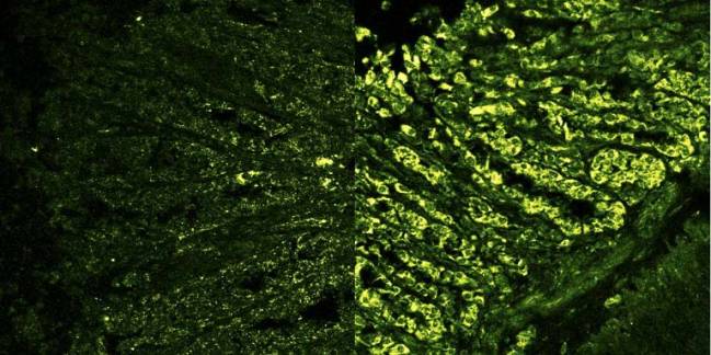 Una presión mecánica acelera las etapas tempranas del cáncer de colon