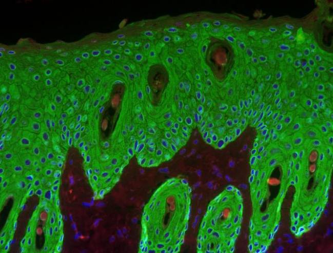 piel hiperproliferativa