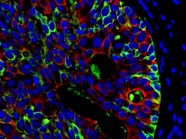 Identifican por primera vez las células que originan el cáncer de próstata humano