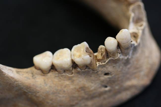 Obtienen material genético antiguo de la bacteria de la caries