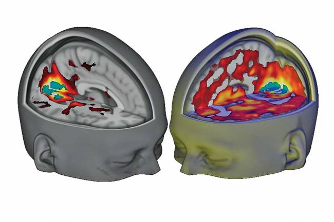 Así se reconecta el cerebro durante un ‘viaje’ de LSD 