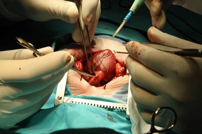 Descubiertas las claves genéticas del fallo de la válvula mitral