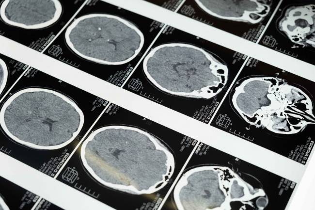 Localizan los microtrombos que agravan el alzhéimer gracias a una técnica no invasiva