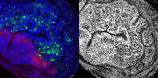 tumor epitelial