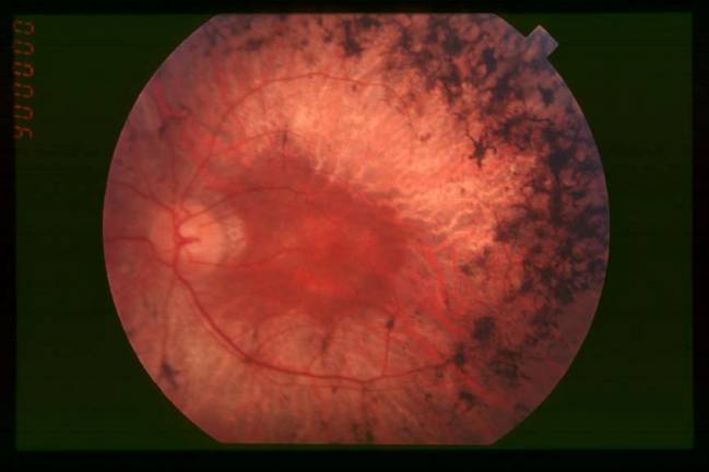 Aplican una nueva técnica para avanzar en el estudio de la retinosis pigmentaria