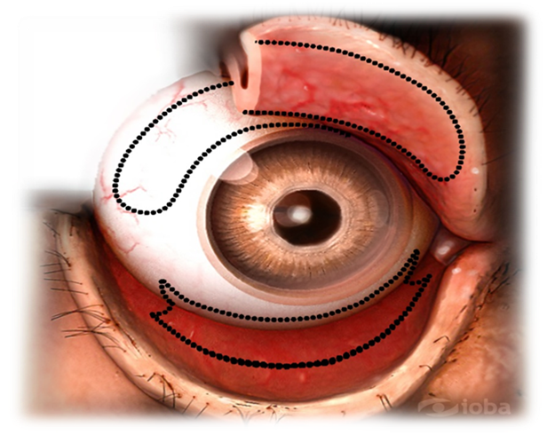 Avances en el estudio del sistema inmune de la superficie ocular