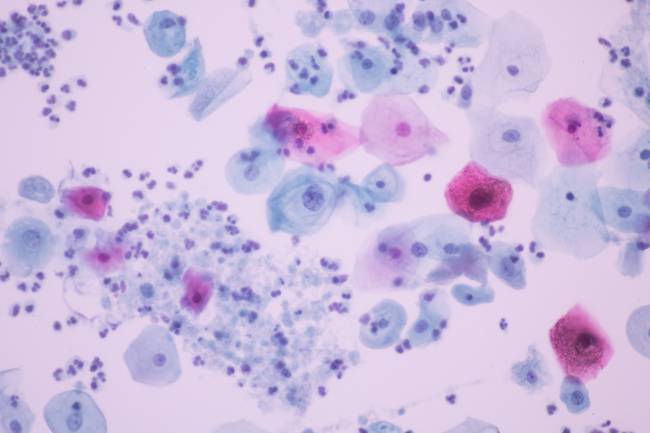 Desarrollan un sistema de IA para detectar una de las infecciones sexuales más frecuentes del mundo