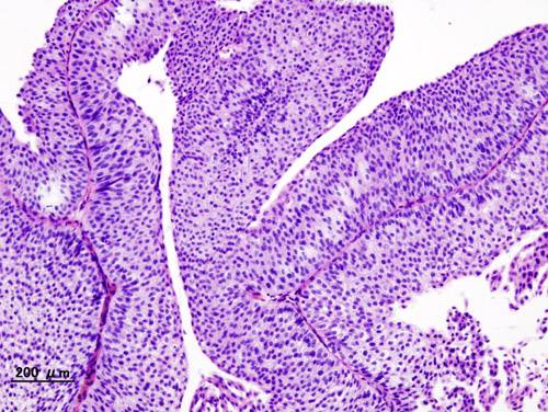 Descrito el mapa del genoma del cáncer de vejiga