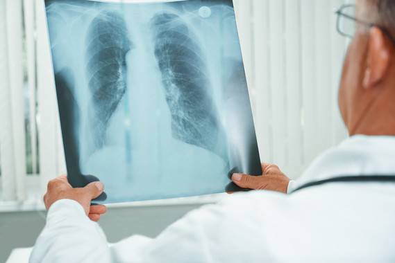 Descubierta una posible diana terapéutica contra la hipertensión pulmonar