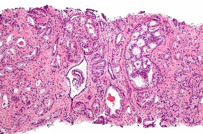 Descubren el talón de Aquiles del cáncer de próstata neuroendocrino