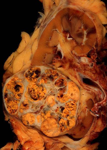 Descubren las primeras variantes asociadas con el cáncer de riñón