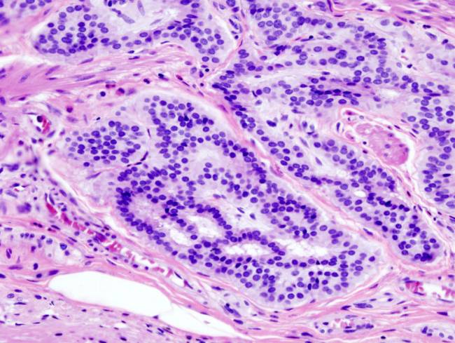 El cáncer colorrectal reduce su capacidad metastásica en ausencia de una proteína