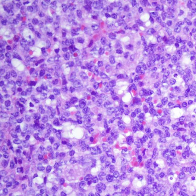 El desarrollo de leucemia linfoblástica aguda está vinculado a la exposición infecciosa