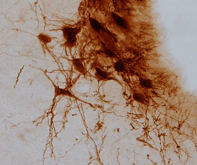 El dolor diabético y la ansiedad comparten un mecanismo cerebral común