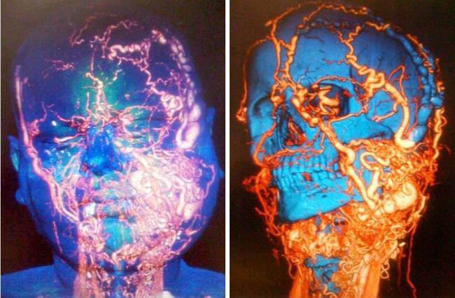 El hospital Vall d’Hebron realiza con éxito un nuevo trasplante de cara