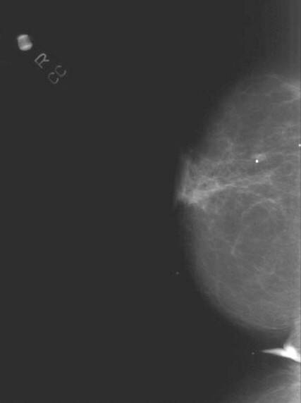 El incremento de la densidad mamográfica aumenta el riesgo de cáncer de mama