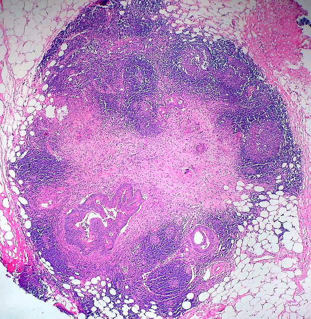 En España se diagnostican más de 500 casos de cáncer de colon por semana