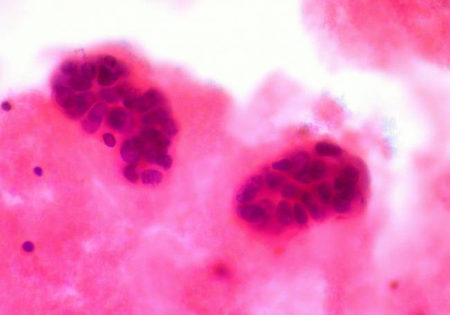 España es uno de los países europeos con menor tasa de mortalidad en cáncer de mama