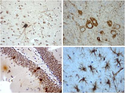 Estudian la conexión molecular entre Alzheimer y Parkinson