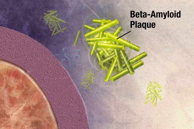 Identifican dos nuevos genes asociados al alzheimer