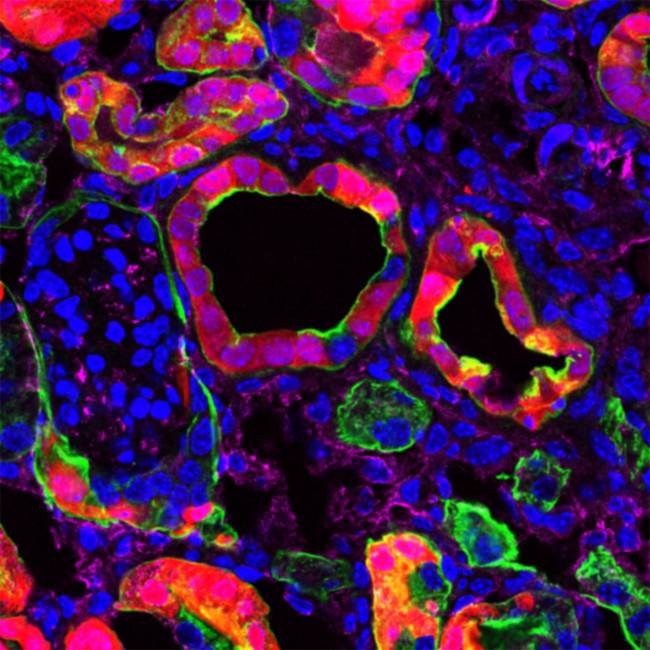 Identifican el gen que provoca la aparición de la fibrosis renal