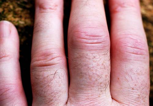 Identifican un nuevo mecanismo de producción de anticuerpos clave para el lupus o la artritis reumatoide