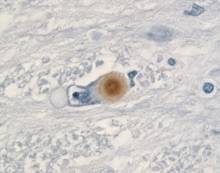 Identifican una de las razones de la muerte neuronal de los enfermos de párkinson