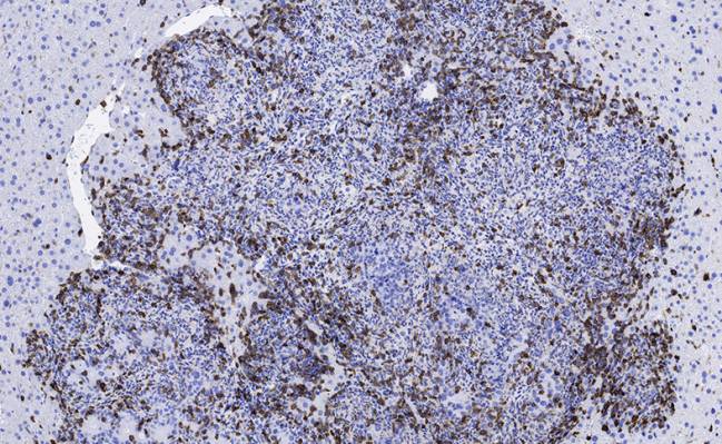 Inmunoterapia y un inhibidor hormonal para tratar tumores de colon agresivos
