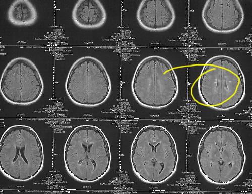 La eficacia del tratamiento de esclerosis múltiple se podrá predecir para cada paciente